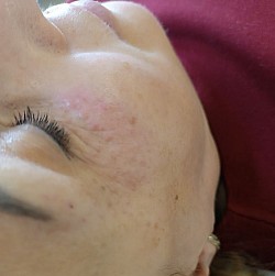 Мезотерапія від зморшок довкола очей. Косметолог Вроцлав.